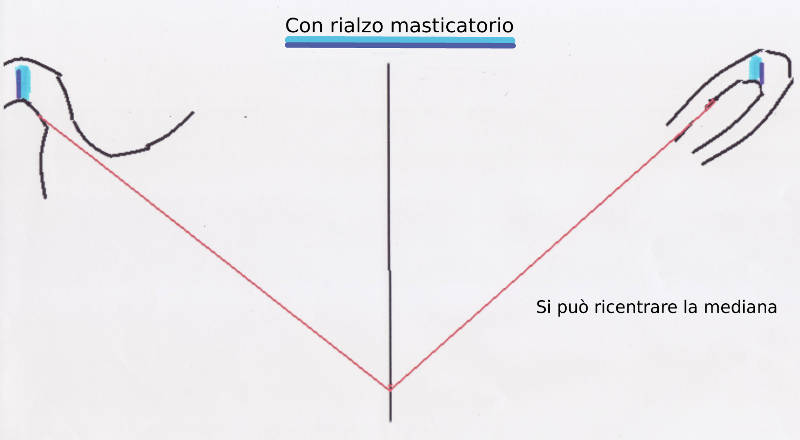 Rialzo masticatorio